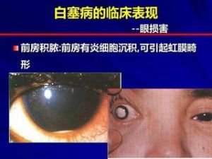 白塞病