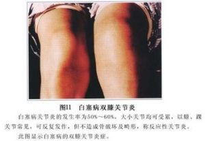 白塞病