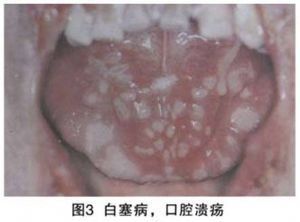 白塞病